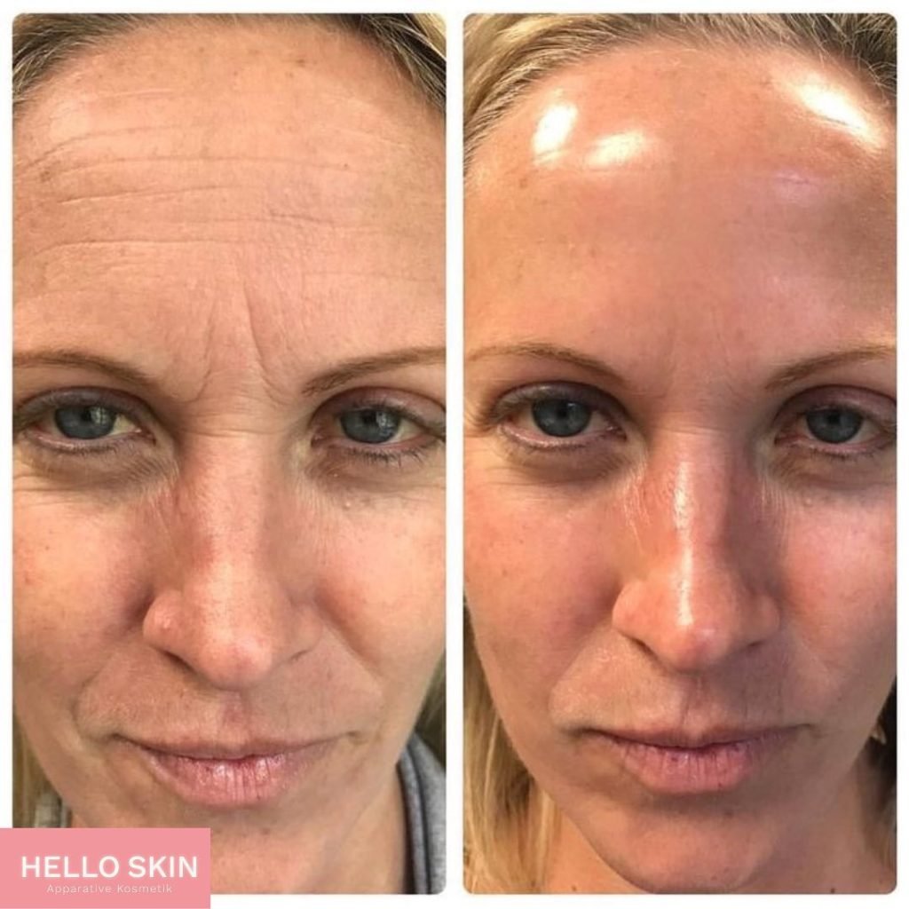 red light therapy before and after skin results comparison