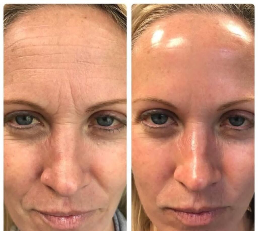 red light therapy before and after acne skin treatment results