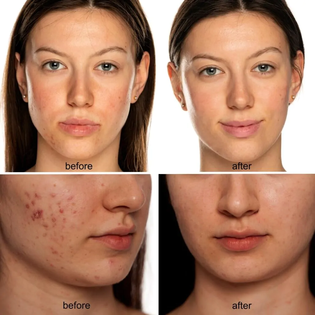 yellow light therapy benefits using LED face mask treatment before and after anti aging LED light therapy face mask treatment rosacea LED light therapy before and after results on facial redness